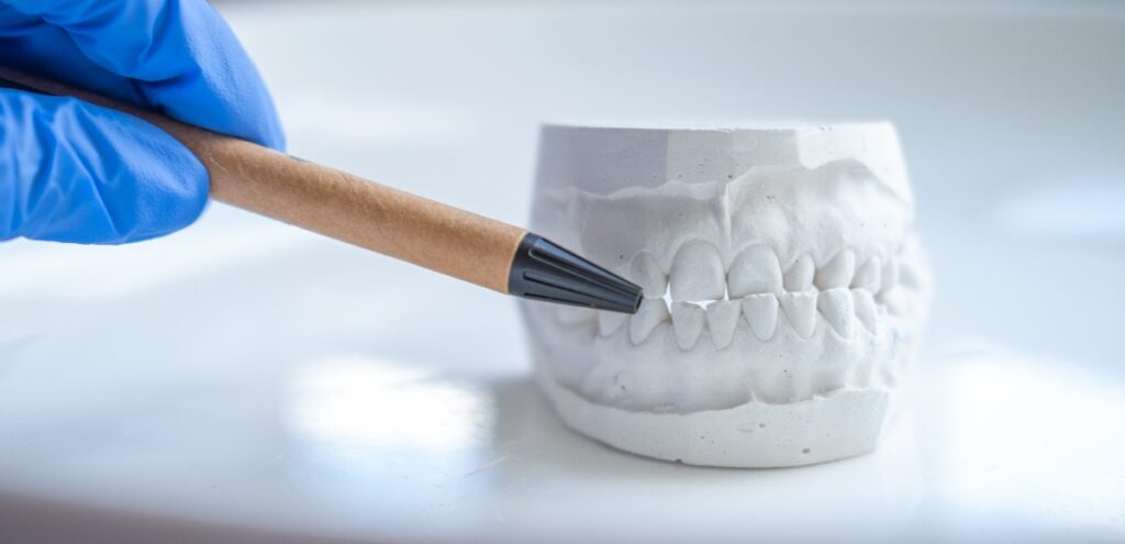 malocclusione dentale