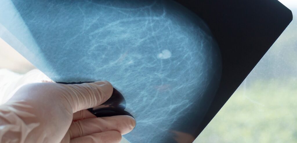 mammografia genova