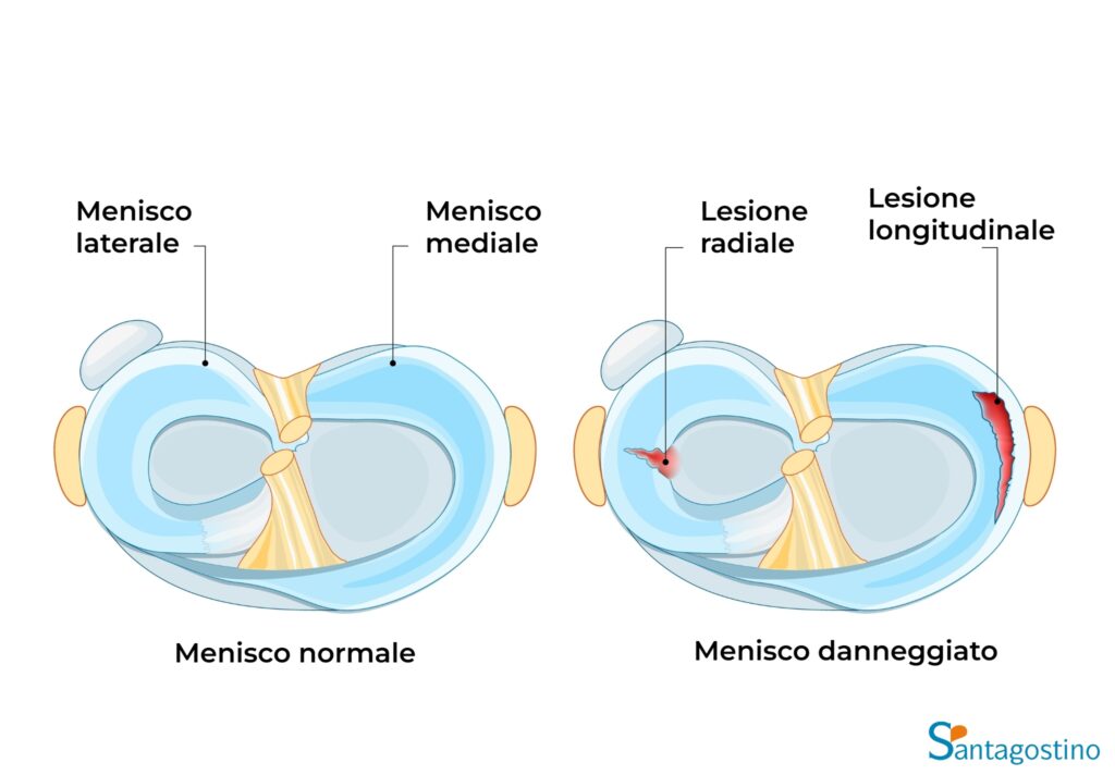 lesione menisco santagostino genova