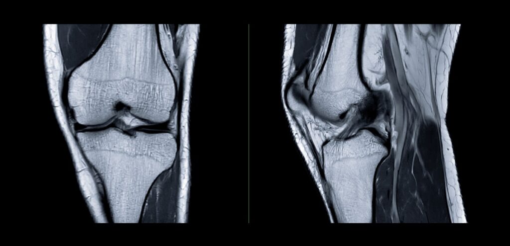 risonanza-magnetica-ginocchio