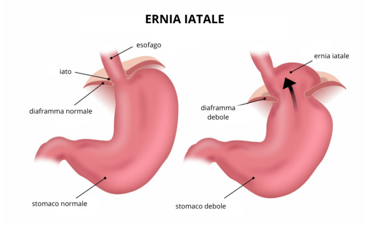 Ernia Iatale Sintomi Cause E Cure Efficaci Santagostino Genova
