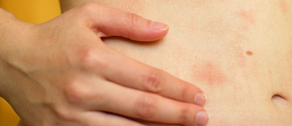 dermatite santagostino genova