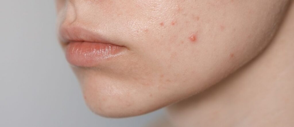 acne genova