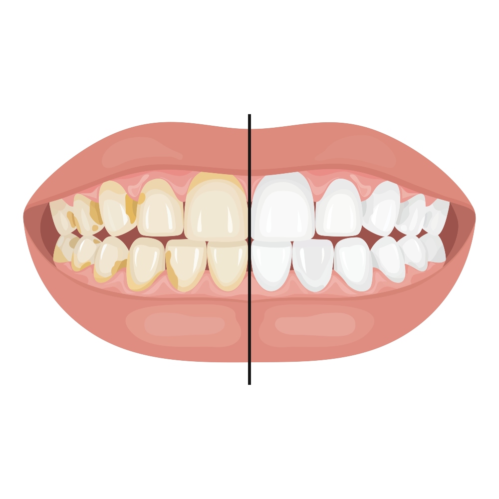 sbiancamento denti santagostino genova 1