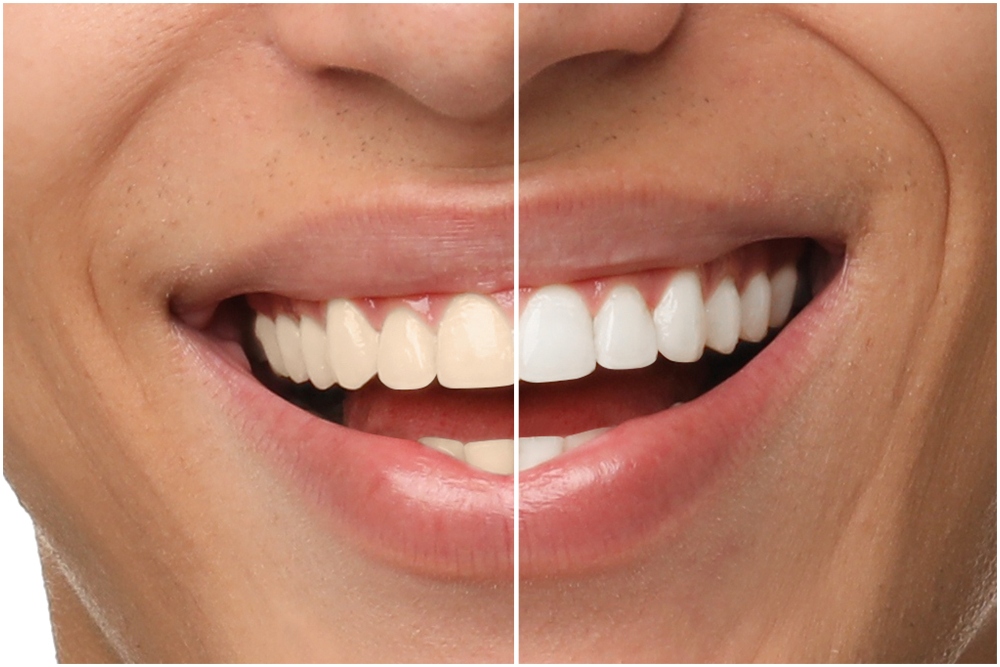 sbiancamento denti santagostino genova 2