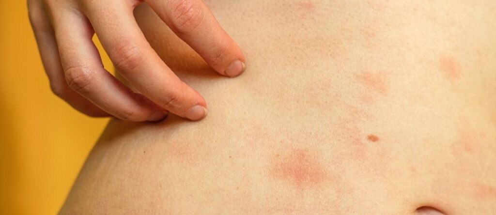orticaria genova